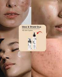 Glycolic Acid 7% 😍 Glow Toning Solution | Today Sale🔥45% OFF